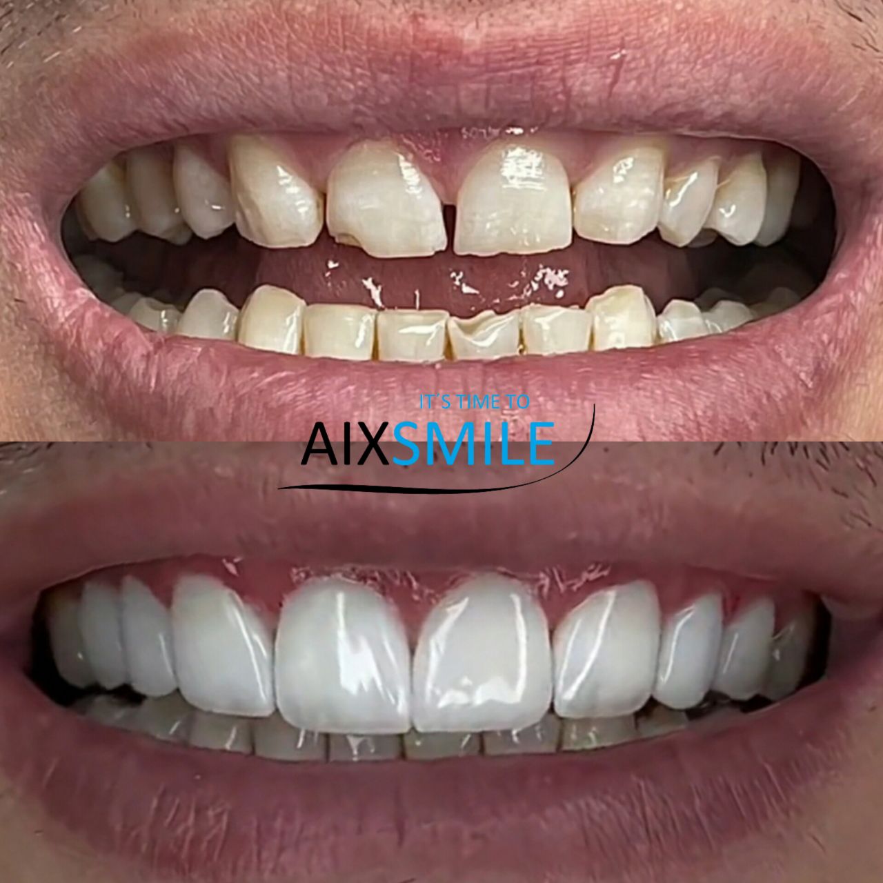 Veneers before-and-after comparison, case 1
