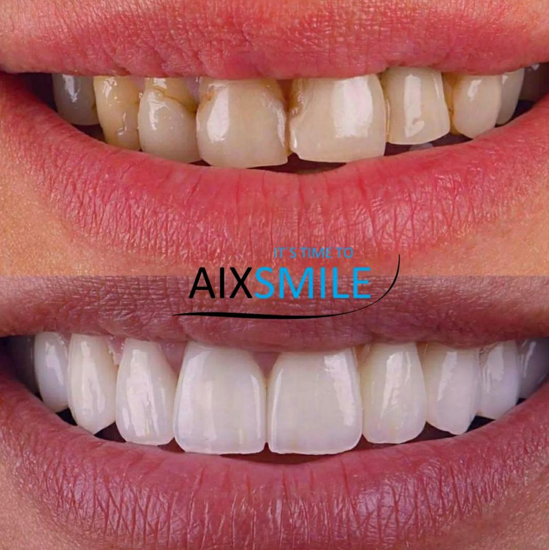 Veneers before-and-after comparison, case 2