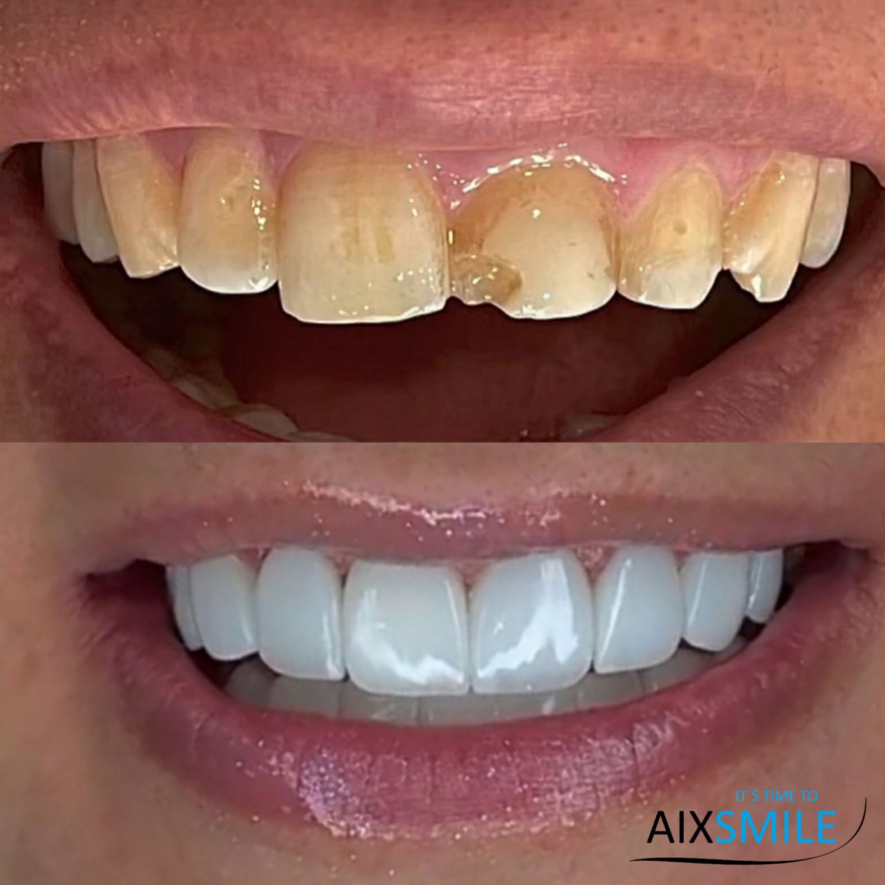 Veneers before-and-after comparison, case 4