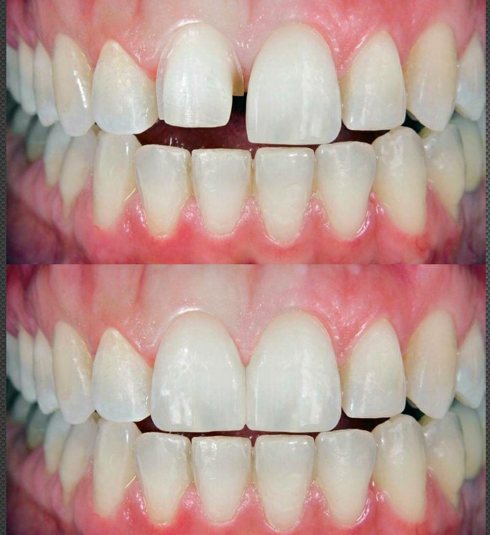Veneers before-and-after comparison, case 5