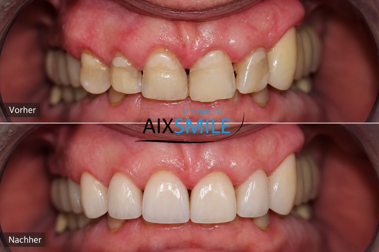 Veneers before-and-after comparison, case 6