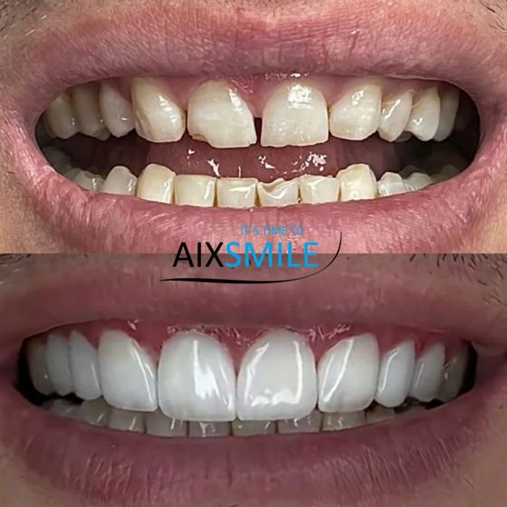 Veneers before-and-after comparison, case 1