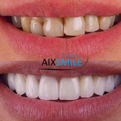 Veneers before-and-after comparison, case 2