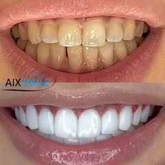 Veneers before-and-after comparison, case 3