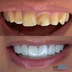 Veneers before-and-after comparison, case 4