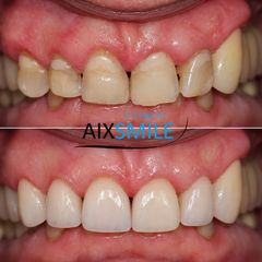 Veneers before-and-after comparison, case 6