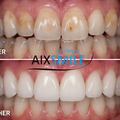 Veneers before-and-after comparison, case 7